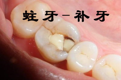 一般补牙需要多少钱