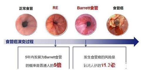 痰中带少量血丝是怎么回事