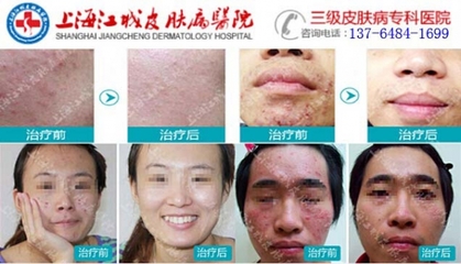 上海专业治疗痘痘痤疮