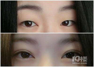 哪做双眼皮好