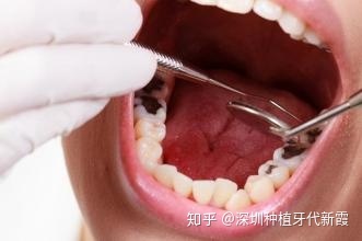 补牙后多久可以吃东西