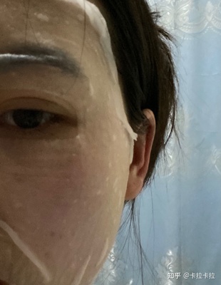 激光点痣会留疤