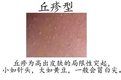 挤痘痘出来的白色的东西是什么