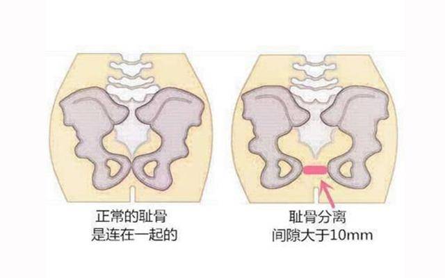 孕妇 耻骨联合分离