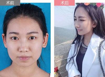 隆鼻等老了以后后遗症