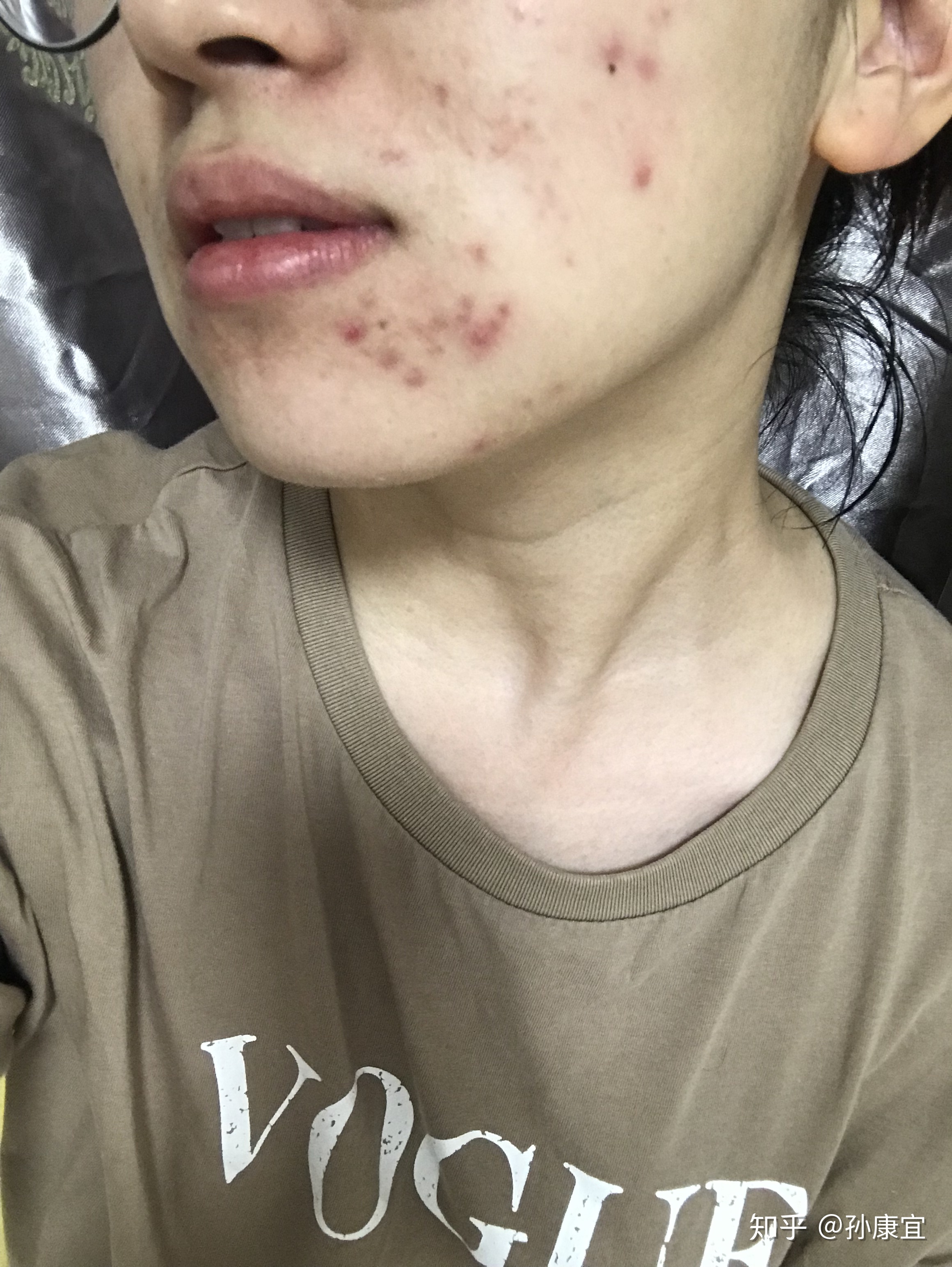 鼻子有痘痘能挤吗