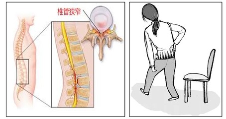 腰椎狭窄怎么治疗效果最好
