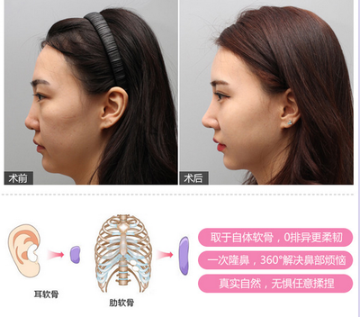 自体软骨隆鼻的缺点