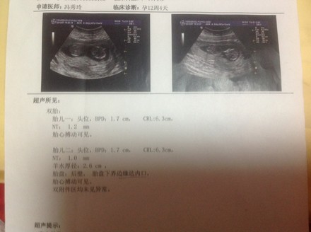 怀孕19周感觉不到胎动