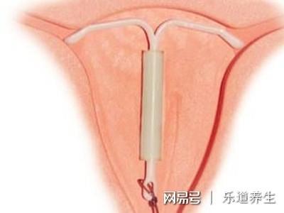 上环为什么会怀孕
