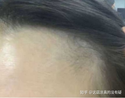 发际线有痘痘