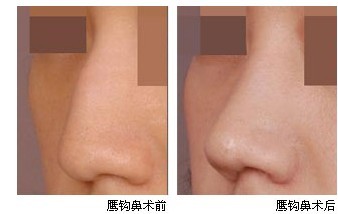 鼻孔畸形手术多少钱