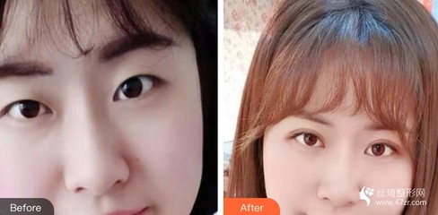 双眼皮做美瞳线好看吗
