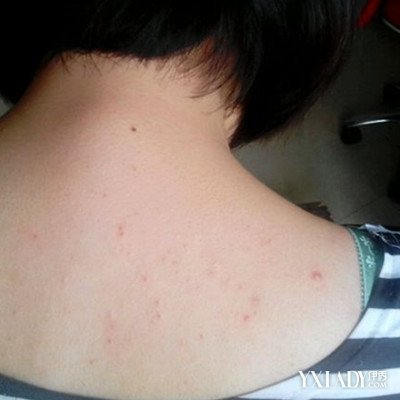 背后长痘痘用什么