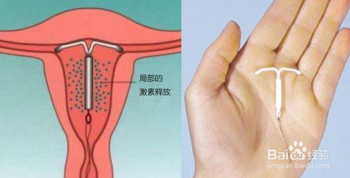 带环怀孕了怎么做流产