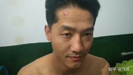 额头上疤痕怎么去掉