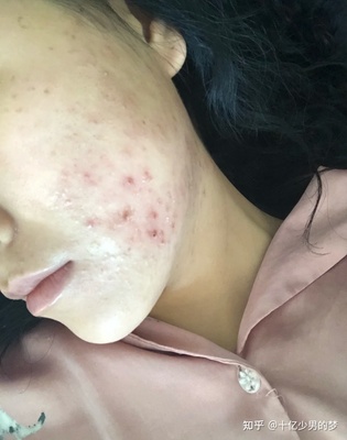 脸颊长痘痘红肿