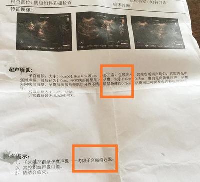 怀孕检测报告单