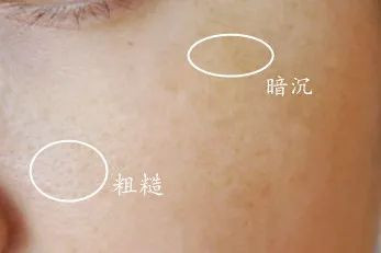 水光针和光子嫩肤哪个好
