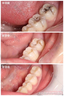 补牙整套多少钱