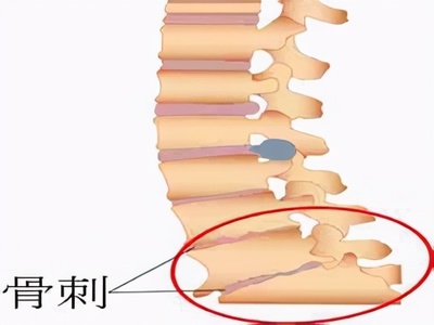 骨刺增生怎么治疗