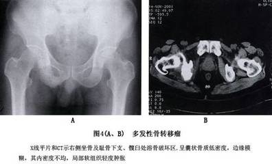 股骨头坏死检查需要多少钱