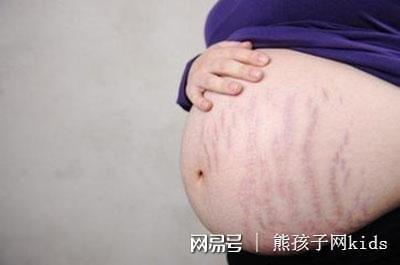 怀孕没有妊娠纹