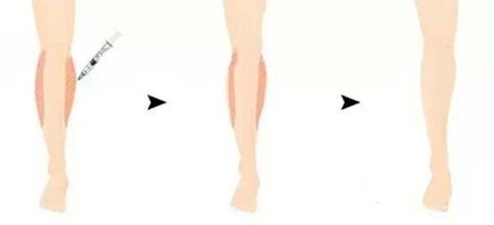 小腿瘦腿针能瘦多少cm