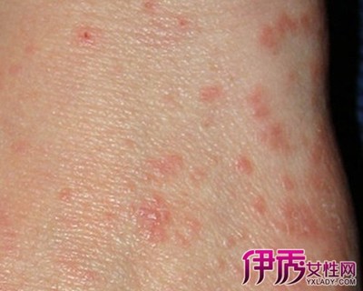 身上长疥疮怎么治疗