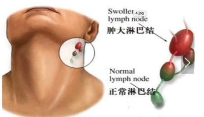 颈部淋巴结核怎么治疗