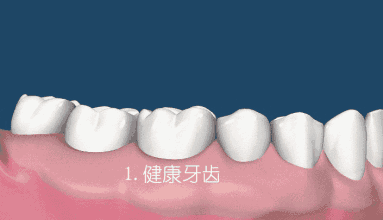 茶渍保护牙齿