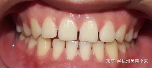 牙龈疼怎么治疗