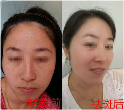 去斑美白要多少钱