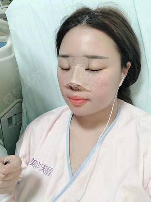 哪里自体隆鼻效果好