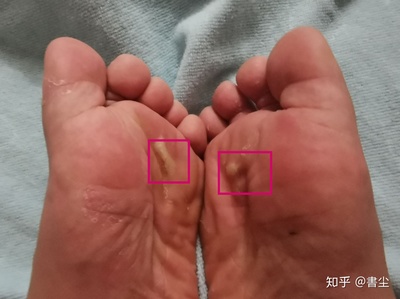 脚底板热是怎么回事