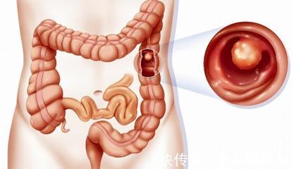 肠息肉是怎么回事