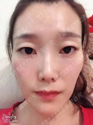 镇江割双眼皮