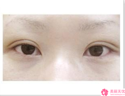 为什么双眼皮会变成三眼皮