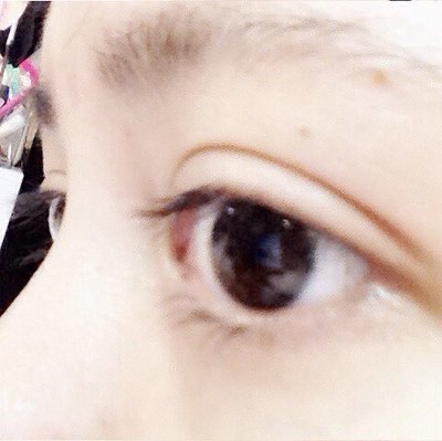 做完双眼皮冰敷多久