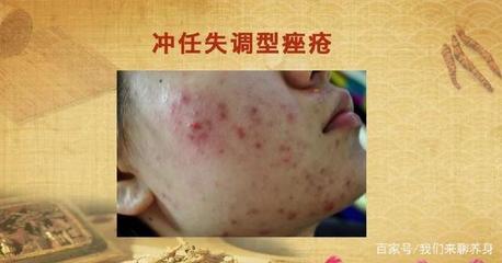 月经前痘痘严重怎么办
