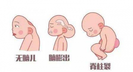胎儿发育畸形