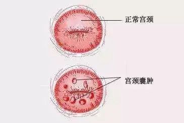 宫颈纳囊怎么治疗最好的方法