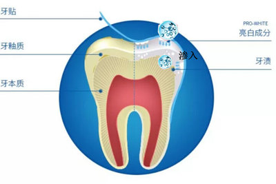 牙齿美白的原理