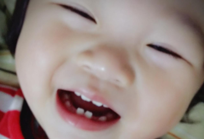 新生儿长牙