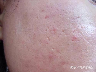 闭口痘痘粗糙