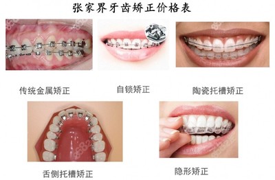 矫正牙齿隐形牙套价位
