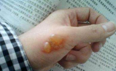烫伤怎样不留疤痕