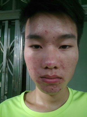 32岁满脸长脓包痘痘