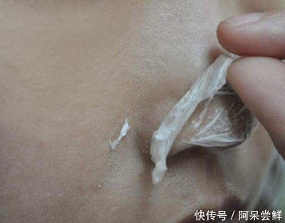 毛孔有白色条状物