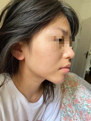 脸上起痘痘留疤怎么办